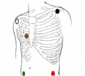 心電監護5個電極位置圖，電極片放置位置在哪？