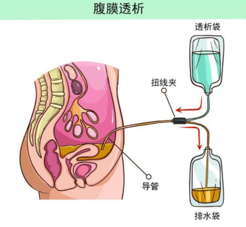 腹膜透析液