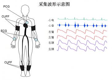 動脈硬化檢測儀的臨床意義，動脈硬化檢測儀的原理與技術！