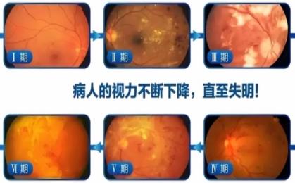 視網膜視力篩查用什么儀器查