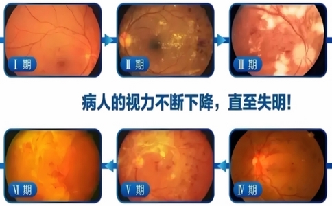 視網膜實力篩查儀