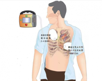 心電圖機的正確使用步驟是什么？朗逸器械百科